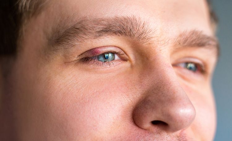 Najčastejším dôvodom vzniku jačmeňa na oku je infekcia
