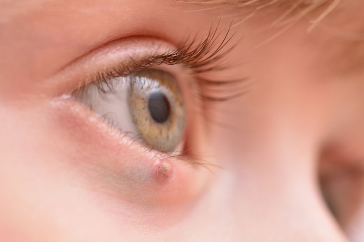 Jačmeň na oku sa nezriedka objavuje aj u malých detí