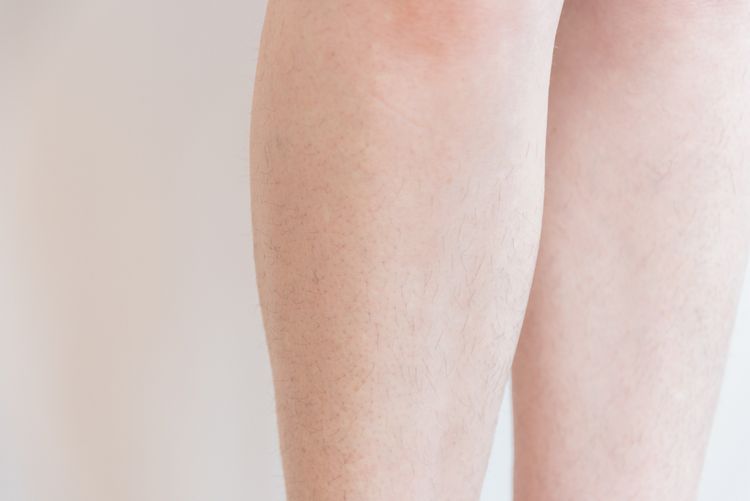 Častým dôsledkom holenia nôh sú zarastajúce chĺpky