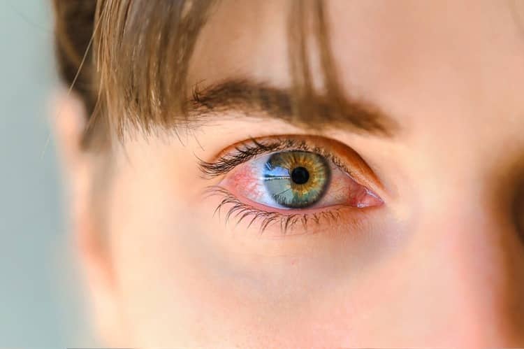 Podráždené oči z kontaktných šošoviek