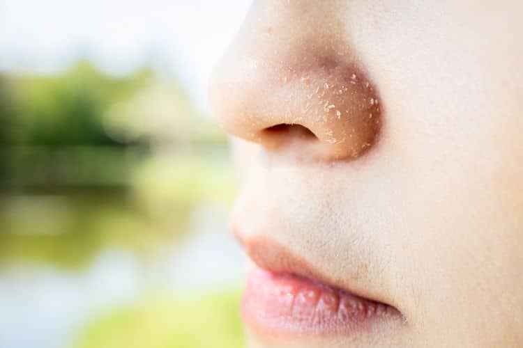 Citlivým miestom je tvár, suchá pokožka sa často objavuje na nose