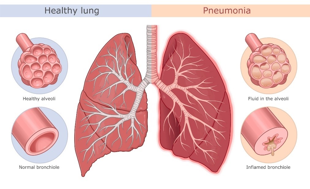 Zdravé pľúca (čisté alveoly a bronchioly) a pneumónia (zápal pľúc, zapálené alveoly a bronchioly s tekutinou/hnisom).