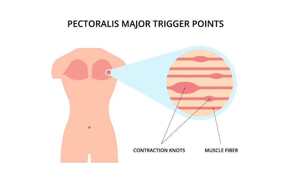 Veľký prsný sval a trigger point (iritačný bolestivý bod) v preťaženom/natiahnutom svalovom vlákne.
