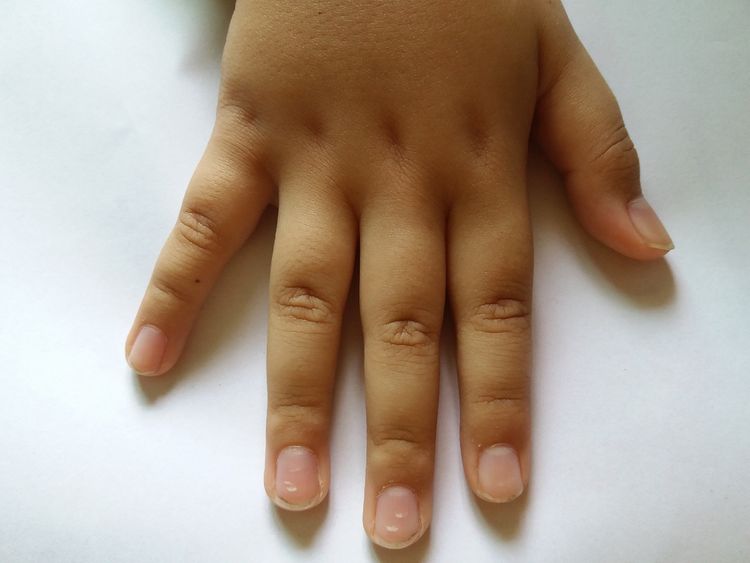 Biele škvrny na nechtoch u detí spôsobuje aj nedostatok vitamínov