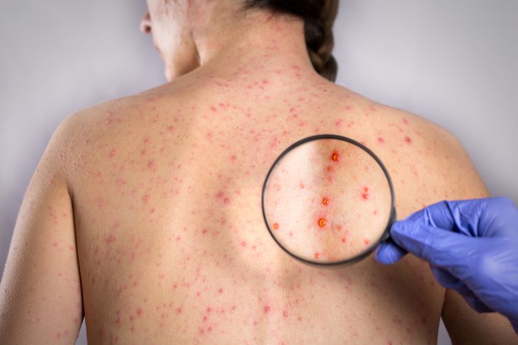 Jedným z príznakov mononukleózy je vyrážka na chrbte