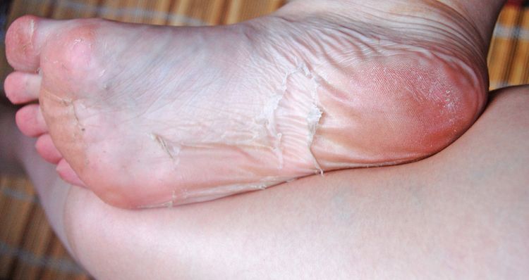 Zlupovanie kože na nohách po exfoliácii
