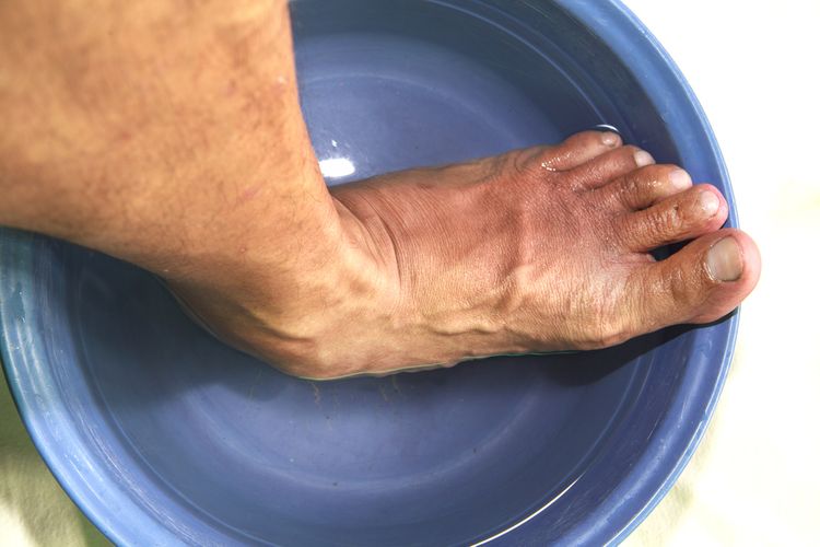 Domáca liečba mykózy - močenie si nôh v kúpeli