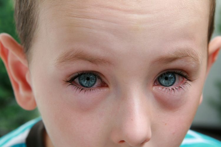 Krvavé oči sú u detí pomerne bežnou záležitosťou
