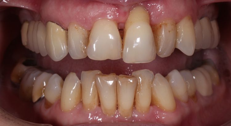 Zuby postihnuté paradentózou