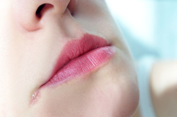 Infekcia v kútiku úst spôsobená kvasinkou alebo baktériou