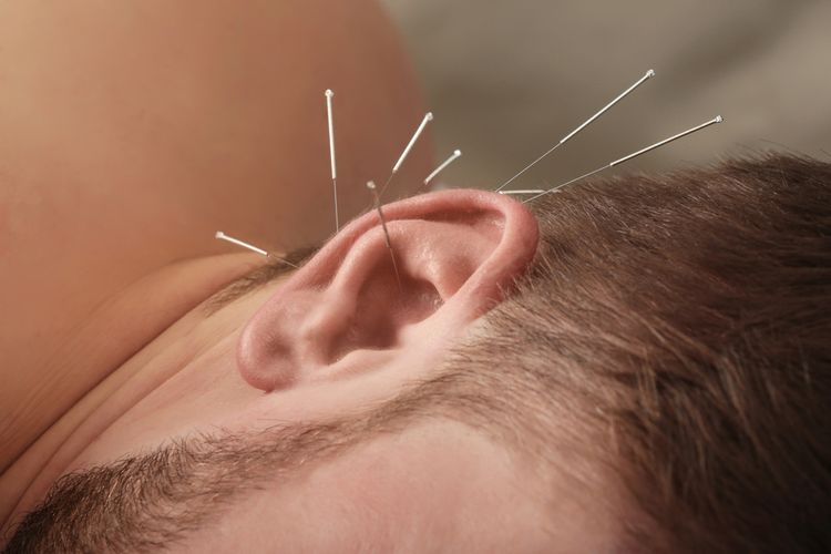 Ucho napichané akupunktúrnymi ihlami