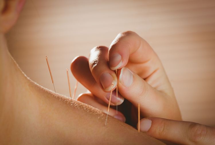 Akupunktúra - ošetrenie krku 