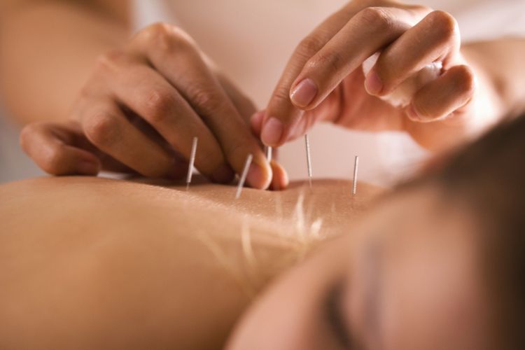 Liečba akupunktúrou