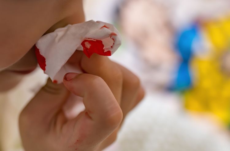 U malých detí je krvácanie z nosa pomerne bežnou záležitosťou