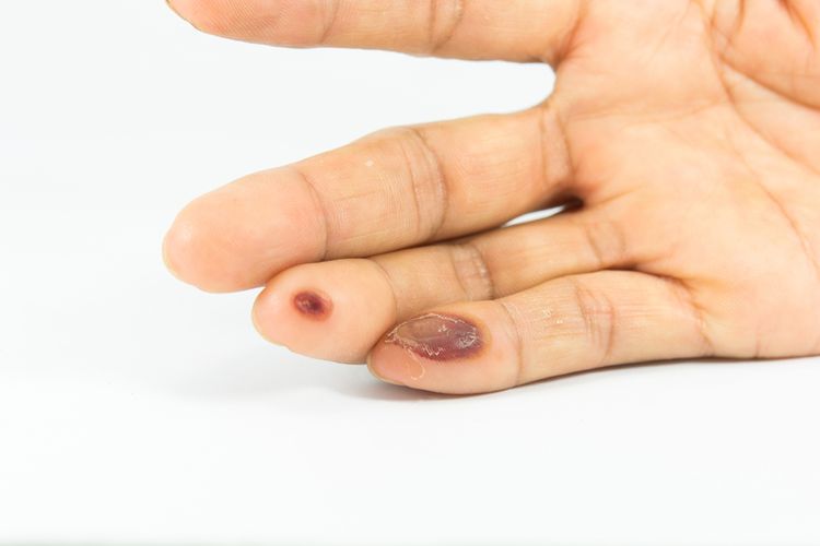 Pľuzgier na prste ako dôsledok popáleniny