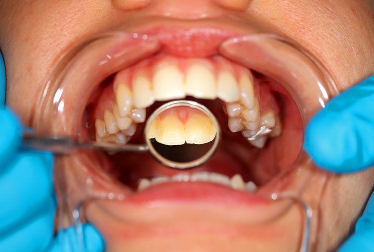 Kontrola zubného kameňa na zubnej prehliadke