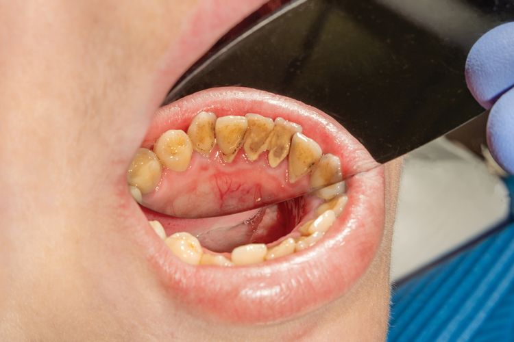 Zuby so zubným kameňom