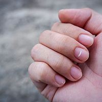 Biele škvrny na nechtoch u detí, dospelých a v tehotenstve. Príčiny a liečba