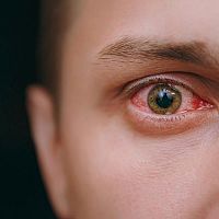 Prasknuté cievky v oku – červené žilky zaliate krvou