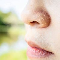 Popraskaná a suchá pokožka (čo ju spôsobuje, ako sa jej vyvarovať)