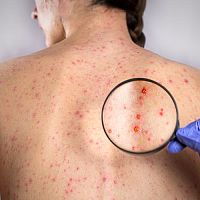 Diéta pri mononukleóze