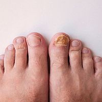 Pleseň na nohách aj u detí. Na liečbu ocot, masť aj lieky