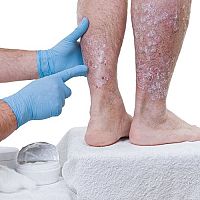 Inovatívne možnosti liečby psoriázy