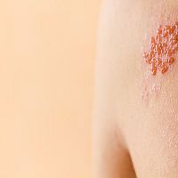 Pásový opar na ruke, chrbte aj hlave – prejavy, príčiny, liečba