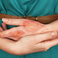 Prvá pomoc pri ošetrení popálenín