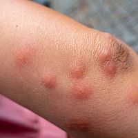 Ako sa zbaviť svrbenia a štípancov po komároch?