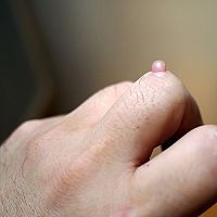 Ako odstrániť bradavice na tvári, krku, ale aj nohe? Domácu liečbu ponúka lekáreň