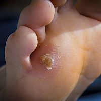 Ako sa zbaviť kurieho oka? Vyskúšajte náplaste alebo ceruzku na kurie oko