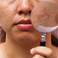 Krémy na pigmentové škvrny na tvári ako účinná liečba. Pomáha aj citrón.