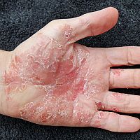 Psoriáza vo vlasoch i na tvári. Príznaky a liečba psoriázy u dospelých i detí