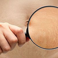Strie na prsiach, bokoch a nohách po pôrode – ako sa ich zbaviť? Pomáhajú krémy?