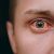 Prasknuté cievky v oku – červené žilky zaliate krvou