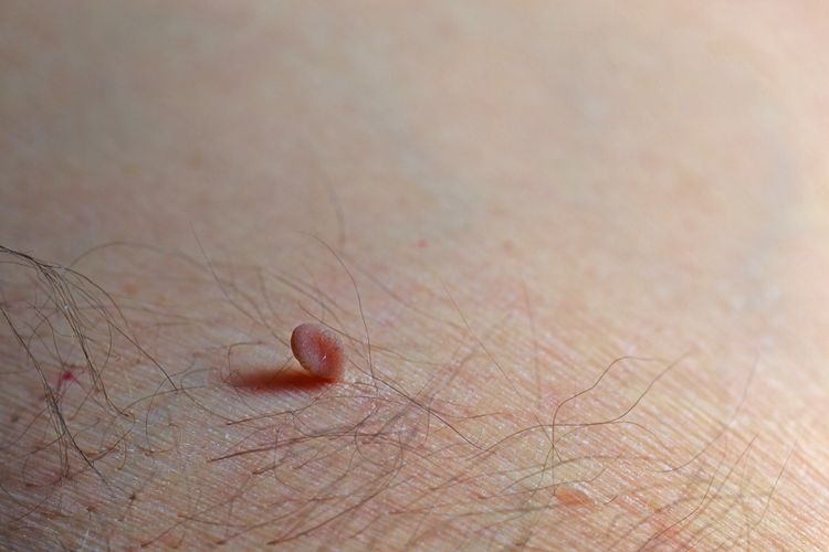 Kožný výrastok - fibróm na koži